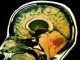 Scientists have discovered that antidepressants and blood thinners can cause brain cancer to eat itself