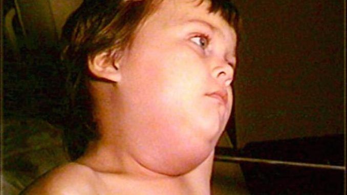 Mumps outbreak in Arkansas is only affecting unvaccinated children