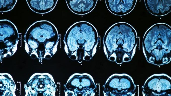 Parasite found to cause Alzheimer's, Epilepsy, Cancer