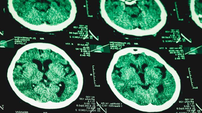 Adderall causes brain damage, study warns