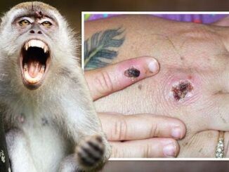 Monkeypox outbreak caused by climate change, scientists claim.