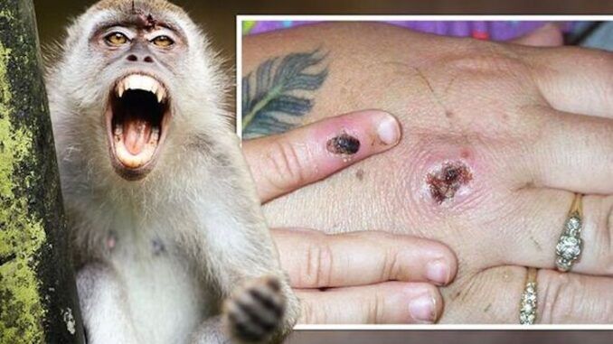 Monkeypox outbreak caused by climate change, scientists claim.