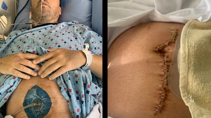 Man loses 6 feet of small intestine due to covid jab injury